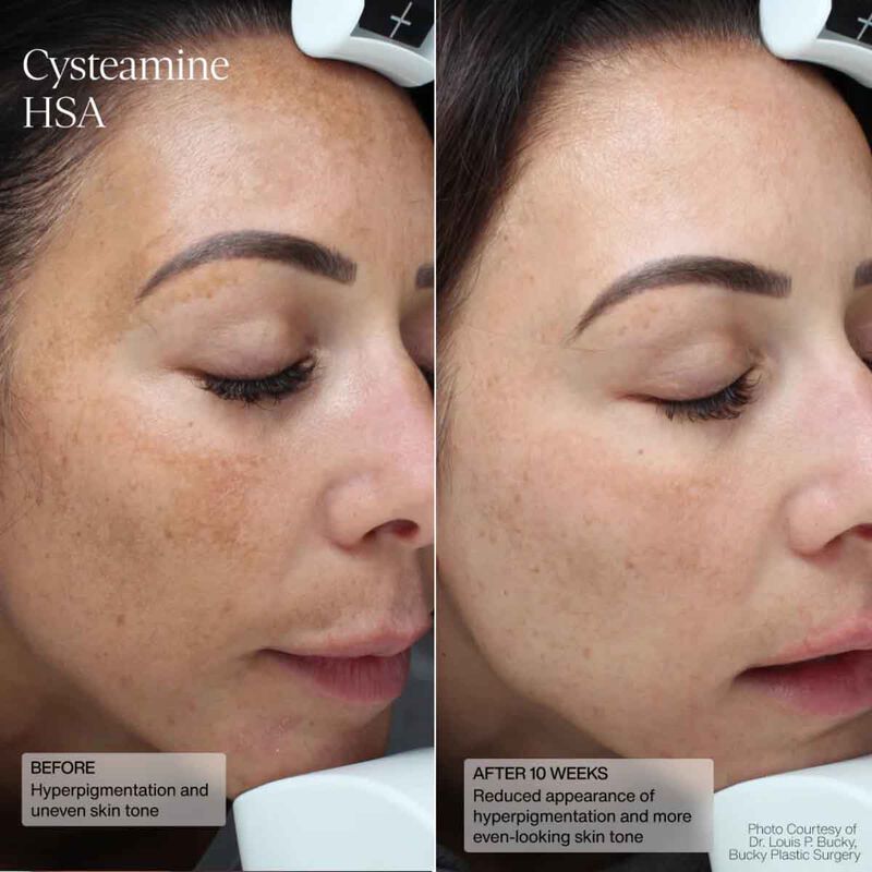 Cysteamine HSA Pigment and Tone Corrector sente cysteamine hsa pigment and tone corrector