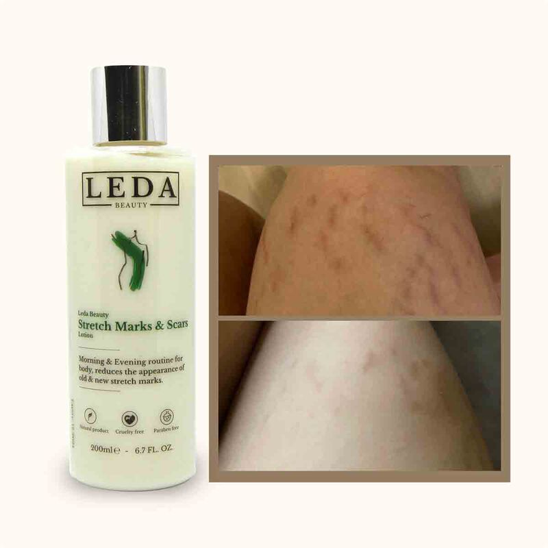 leda stretch marks lotion 200ml