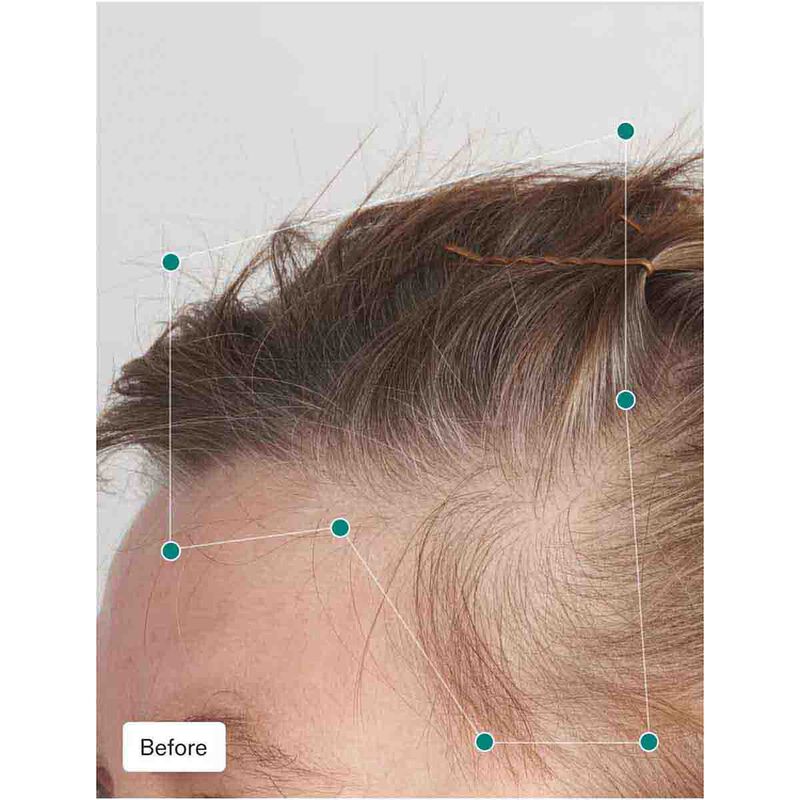 nutrafol balance hair growth pack