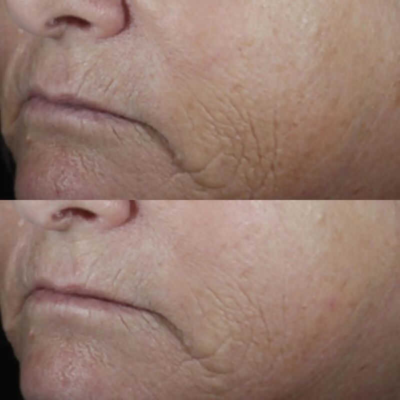 perricone md neuropeptide smoothing facial conformer