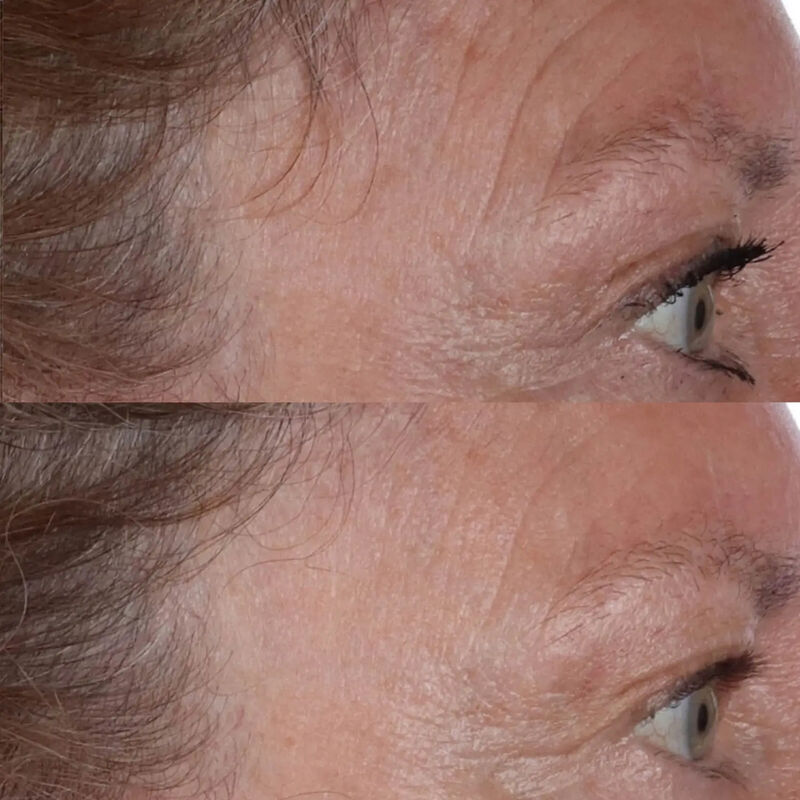 Cold Plasma Plus The Essence perricone md cold plasma plus the essence
