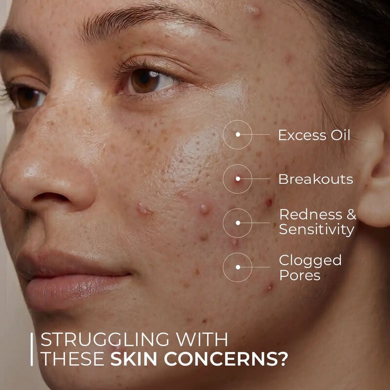 skin centrick كريم ليلي للبشرة المعرضة للحبوب بحمض الساليسيليك 1%